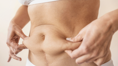 Tummy Tuck