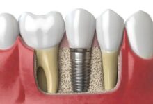 Dental Implants in Singapore Everything You Need to Know