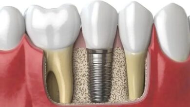 Dental Implants in Singapore Everything You Need to Know