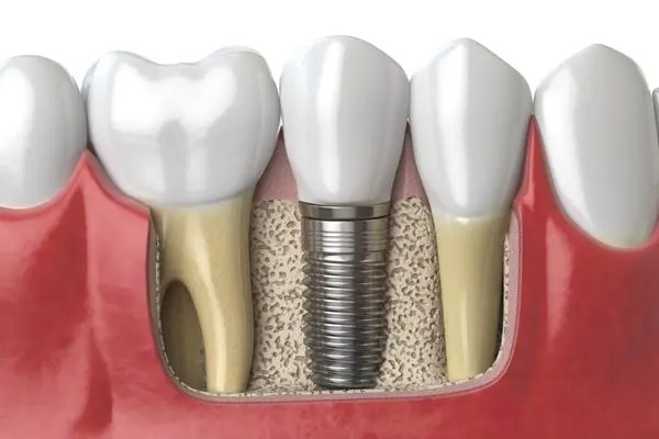 Dental Implants in Singapore Everything You Need to Know